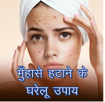 Acne and Pimples Home Remedies